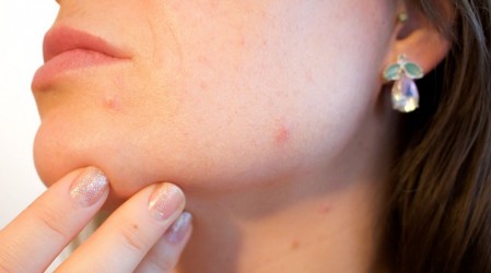 #5TipsLive: Dermatóloga explica qué hacer para evitar la aparición de granitos en cuarentena