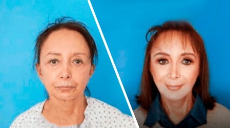Increíble antes y después: Actriz tras la Chilindrina se sometió a radical cirugía de rostro