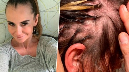 Le detectaron alopecia androgénica: ExMekano Amanda Cibely revela tratamiento que le está curando la calvicie