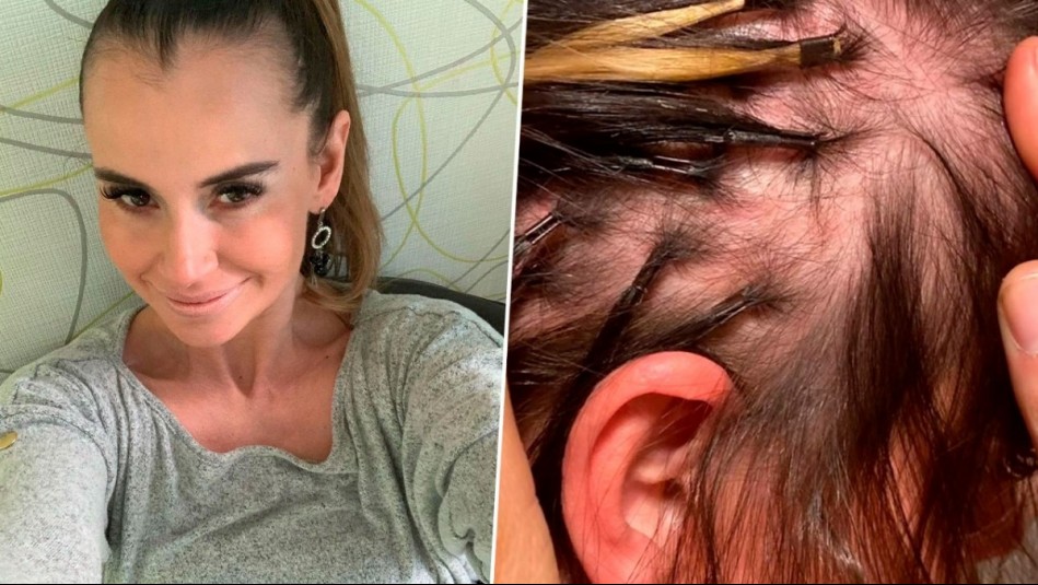 Le detectaron alopecia androgénica: ExMekano Amanda Cibely revela tratamiento que le está curando la calvicie
