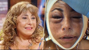 'Mi doctor me sacó la cara': Helhue Sukni explica su impactante operación de rostro en Only Fama