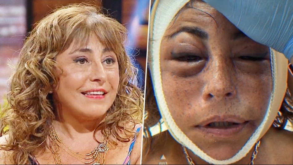 'Mi doctor me sacó la cara': Helhue Sukni explica su impactante operación de rostro en Only Fama