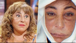 'No le conté a nadie': Helhue Sukni relata el inesperado percance que retrasó su impactante cirugía de rostro