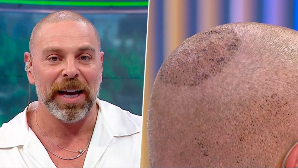 'Sacó pelo por pelo': Neme cuenta detalles del procedimiento estético al que se sometió