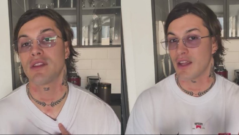 Nicolás Solabarrieta muestra el antes y después de su borrado de tatuajes tras intento fallido: 'Me quemaron'