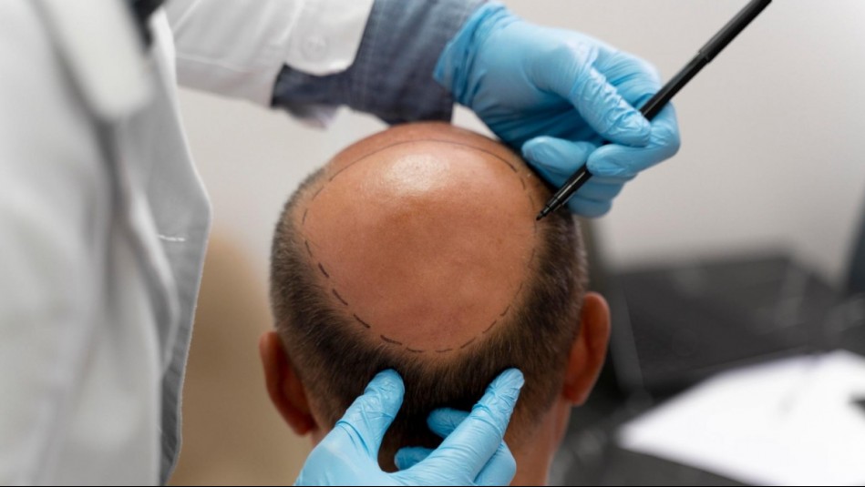 Reconocido locutor radial se somete a implante capilar y narra su experiencia: 'Se ve un poco extraño...'