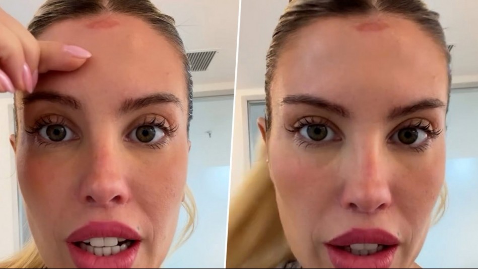 Coté López sufre accidente con artefacto de belleza y queda con una marca: 'No hace nada bien'
