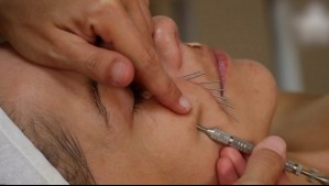 Estudio sugiere que la acupuntura podría 'reconfigurar' regiones del cerebro y ayudar contra la depresión