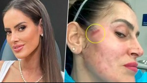 'Me acaba de coser la cara': Adriana Barrientos impacta en redes sociales con inusual procedimiento estético