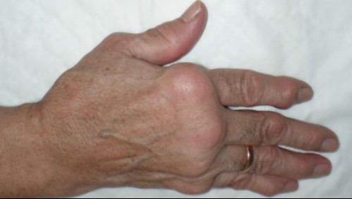 Inflamación en las articulaciones y tendones: ¿Qué es el Síndrome de Reiter?