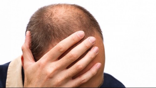 Hombres calvos tendrían mayores probabilidades de sufrir graves síntomas de coronavirus