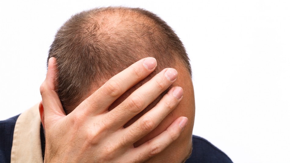 Hombres calvos tendrían mayores probabilidades de sufrir graves síntomas de coronavirus Hombres calvos tendrían mayores probabilidades de sufrir graves síntomas de coronavirus