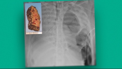 Así quedó el pulmón de una paciente contagiada con coronavirus: Tuvo que ser trasplantada