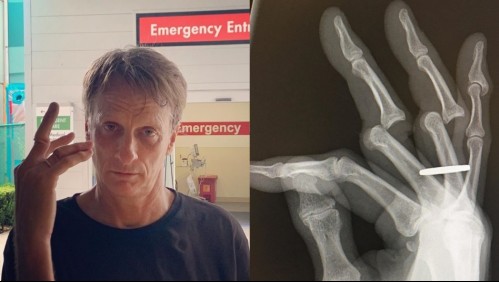 Leyenda del skate Tony Hawk exhibe escalofriante fractura de sus dedos: 'Tuvieron que cortarme el anillo'
