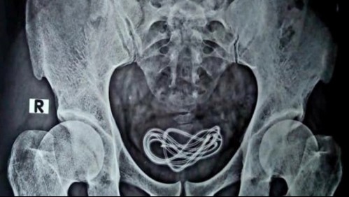 Le extrajeron el cable de un cargador de celular de 60 centímetros de la vejiga: Lo usó como juguete sexual