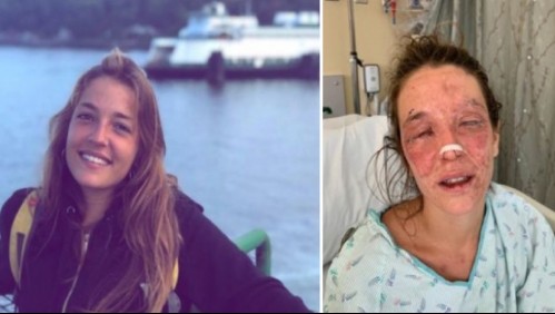 Joven se quemó el rostro y perdió la visión luego de intentar fabricar un jabón de soda cáustica