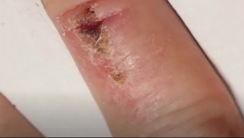 ¿Cómo sanan las heridas? Aquí te explicamos el complejo y fascinante proceso de la cicatrización