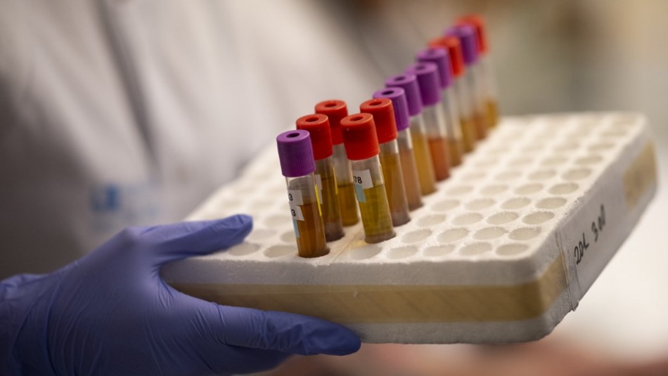 Estudio: Hidroxicloroquina no protege de cuadros graves por coronavirus a largo plazo