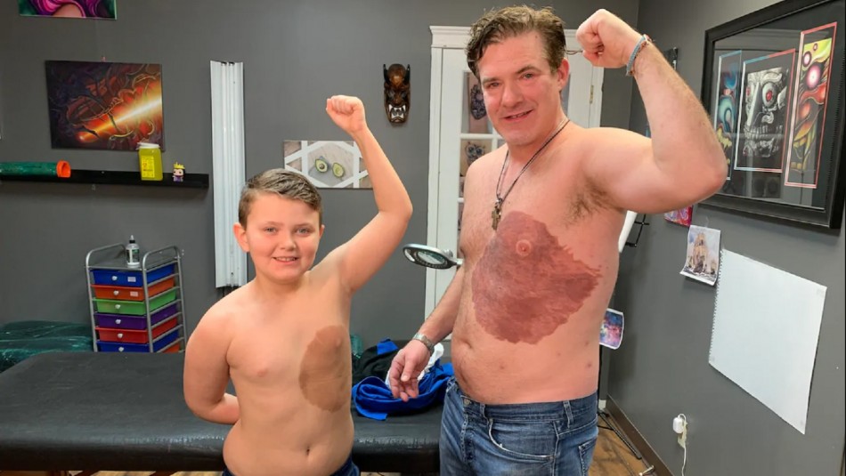 Padre se vuelve viral al tatuarse la misma marca de nacimiento que tanto atormenta a su hijo Padre se vuelve viral al tatuarse la misma marca de nacimiento que tanto atormenta a su hijo