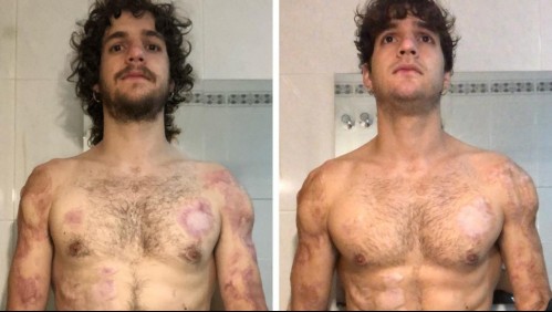 Joven que perdió sus cuatro extremidades por grave enfermedad logra increíble recuperación