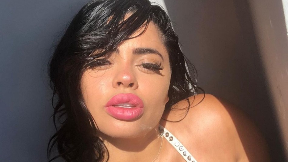Cantante colombiana muestra los daños de los biopolímeros en sus labios Cantante colombiana muestra los daños de los biopolímeros en sus labios