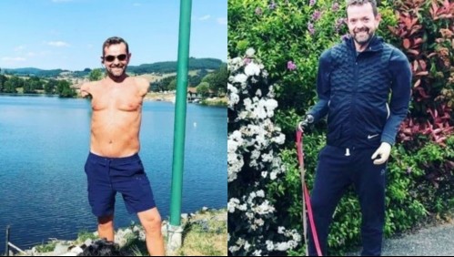 Electricista que sufrió grave accidente recibe doble trasplante de brazos: 'Me gustan mis manos'