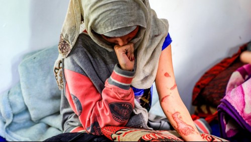 'Me agarró del pelo y derramó el ácido riéndose': Mujer relata brutal ataque de su esposo