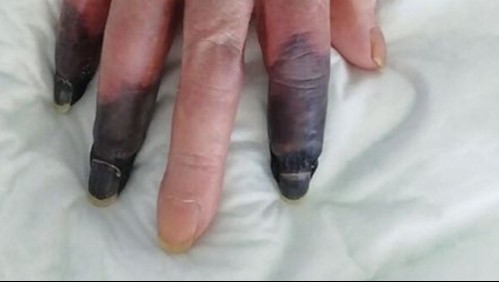 Le amputan 3 dedos a mujer de 86 años porque el coronavirus le provocó gangrena
