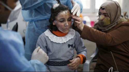 Máscaras impresas en 3D se usan para curar rostros quemados en Gaza
