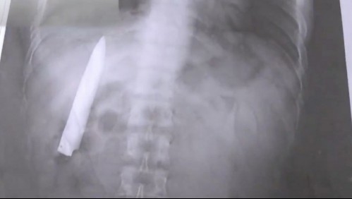 'Siempre sentía dolor': Fue apuñalado hace 14 meses y aún tenía la hoja del cuchillo en su torso