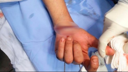 Reimplantan mano amputada a trabajador: Refrigeración de la extremidad fue clave