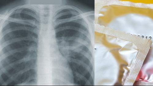 Encuentran preservativo en el pulmón de una mujer: Creían que tenía tuberculosis