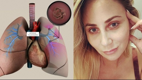 ¿Qué es la trombosis pulmonar? La afección que sufrió la esposa de Mauricio Pinilla