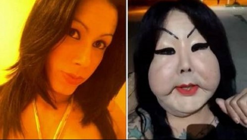 Una mujer trans se inyecta silicona industrial en la cara y sus mejillas se deforman