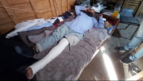 Costurero de 65 años sufre brutal ataque tras robo: Le rompen su pierna por no tener dinero