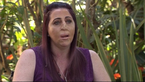 Mujer pierde nariz, labios y las extremidades tras infección por mordedura de una mangosta