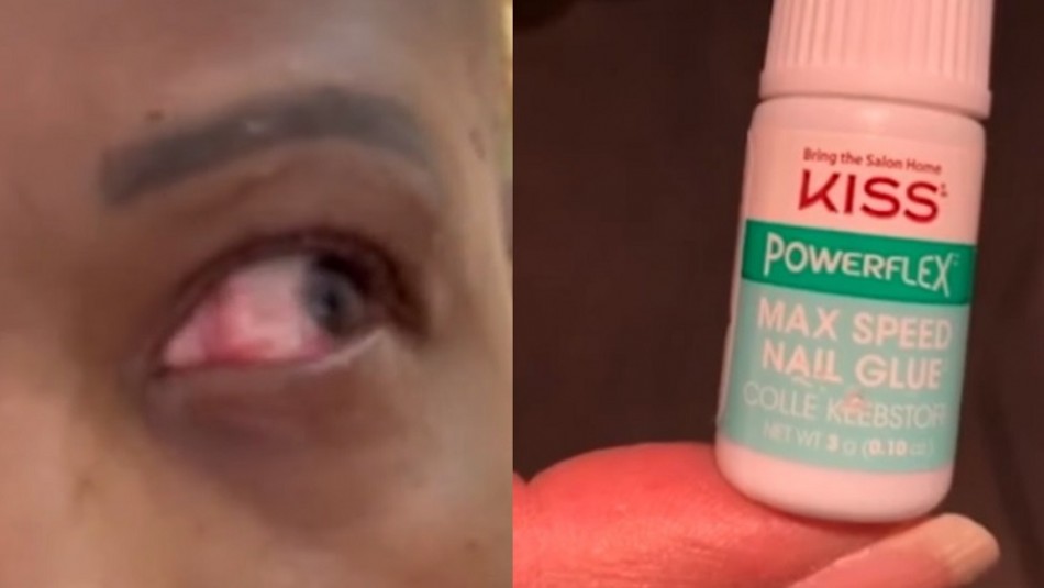 Mujer se aplica pegamento para uñas en un ojo creyendo que eran gotitas lubricantes Mujer se aplica pegamento para uñas en un ojo creyendo que eran gotitas lubricantes