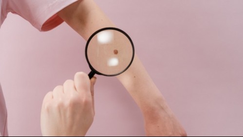 Lunares en la piel: Atiende a estos signos de alerta para acudir al dermatólogo