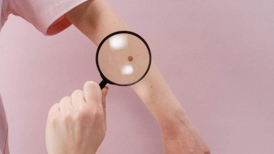 Lunares en la piel: Atiende a estos signos de alerta para acudir al dermatólogo Lunares en la piel: Atiende a estos signos de alerta para acudir al dermatólogo