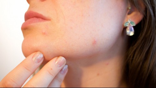 ¿Sirve la pasta de dientes para secar las espinillas?