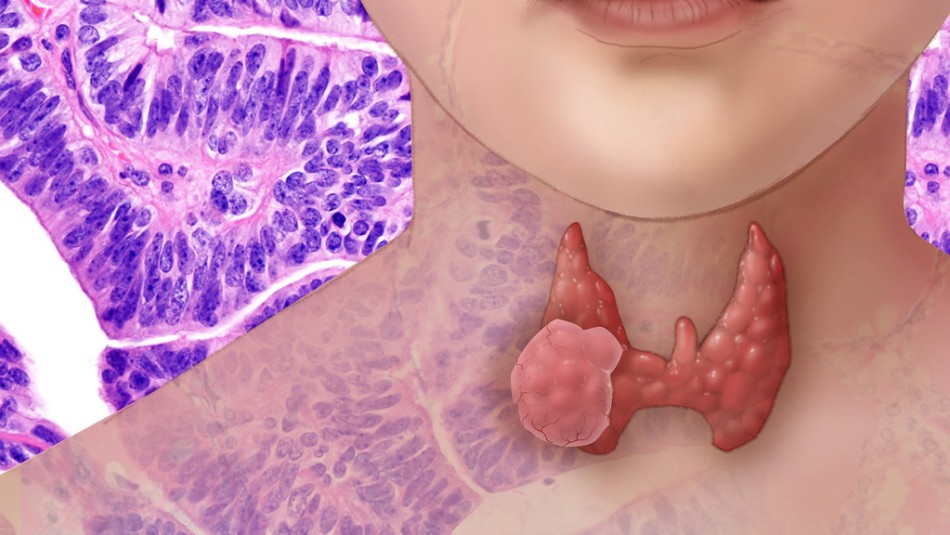 6 síntomas del cáncer de tiroides que debes monitorear