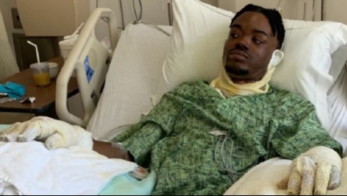 Mujer prende fuego a su pareja mientras dormía porque creía había envenenado sus alitas de pollo