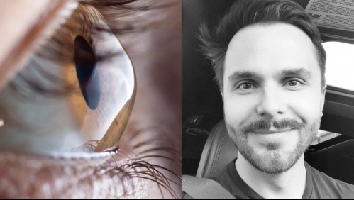 ¿Qué es el queratocono? La enfermedad que redujo en un 15% la visión de Álvaro Ballero