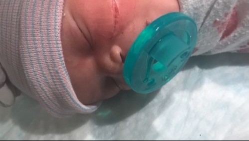 Cortan la cara a una bebé durante una cesárea de emergencia: realizan 13 puntos de sutura