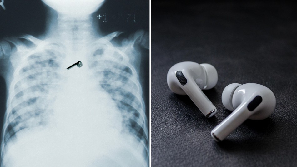 Hombre se queda dormido y se traga uno de sus AirPods: Los audífonos aún funcionan Hombre se queda dormido y se traga uno de sus AirPods: Los audífonos aún funcionan