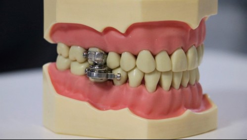 Impide masticar: Lanzan polémico dispositivo para bajar de peso