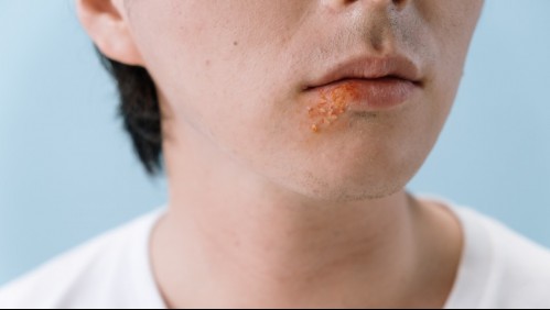 ¿Herpes o afta? Cómo podemos diferenciar las molestias en la boca