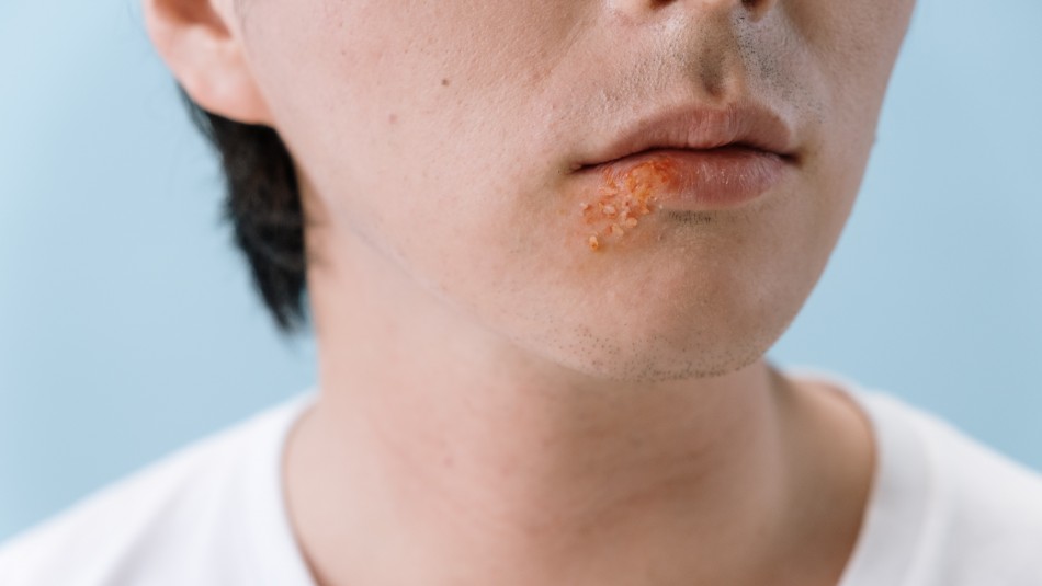 ¿Herpes o afta? Cómo podemos diferenciar las molestias en la boca ¿Herpes o afta? Cómo podemos diferenciar las molestias en la boca