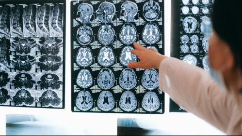 Neuroprótesis: El implante en el cerebro que hace hablar a un hombre tras 15 años de un ACV