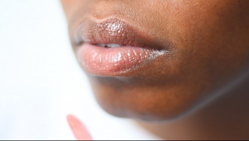 Cáncer de labio: Cómo reconocer los primeros síntomas de la enfermedad